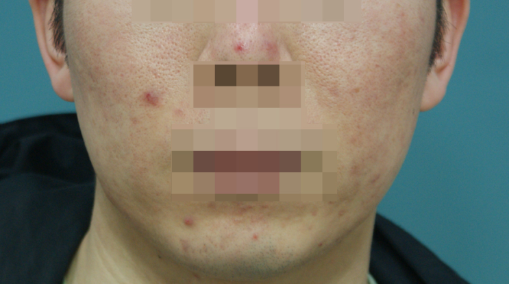 <b>홍대</b>피부<b>한의원</b> 피부가 예민해져 있다면