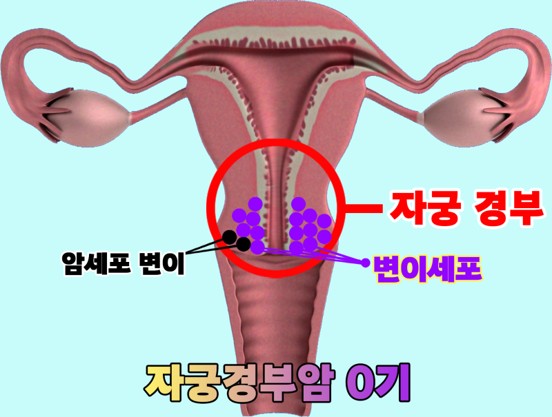 자궁경부암 전단계, 어떻게 관리해야 안전할까?