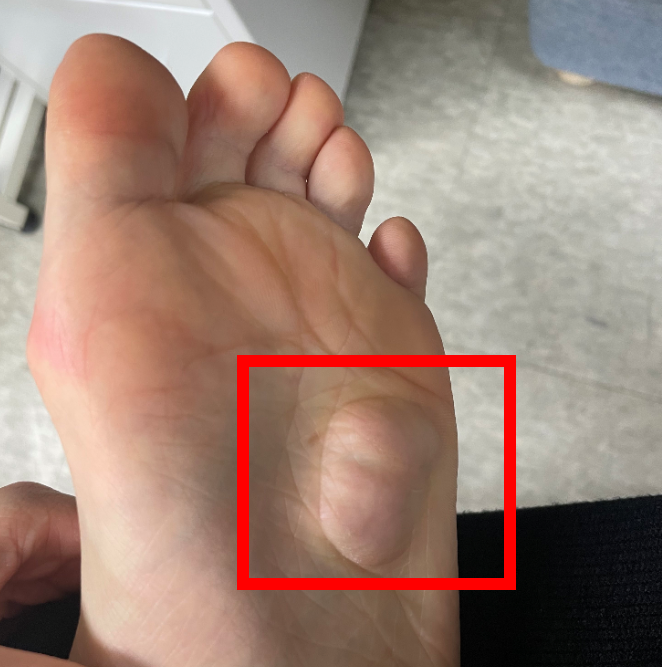 왼쪽 발바닥 종양제거 후기 (신경섬유종? 지방종? 모름)