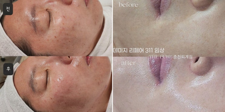  친절한 서비스와 빠른 효과를 경험하는 춘천피부마사지, 더맑은스킨 춘천퇴계점