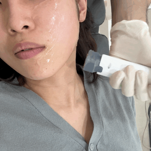  창원 피부과 세르프 레이저 리프팅 일주일 후기 (가격, 통증, 전후 사진)
