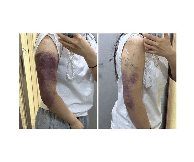  여름 예신다어이트에 최고인 팔뚝살빼는주사 후기 일주일차 (가격, 병원, 통증, 멍)