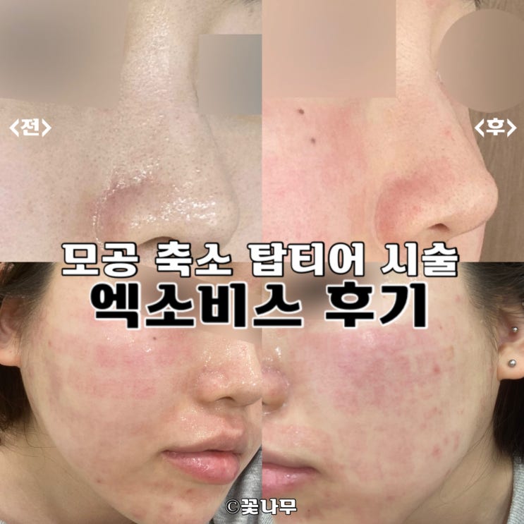  노원피부과 코 나비존 모공 축소 탑티어 스킨부스터 엑소좀 엑소비스 효과 후기