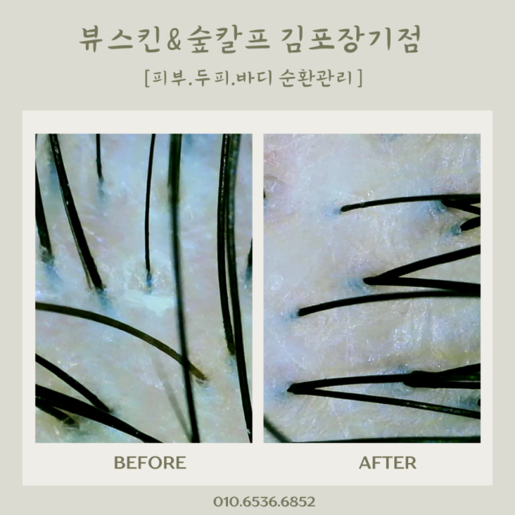  김포장기두피관리 뷰스킨앤숲칼프에서 스켈링 관리 솔직후기