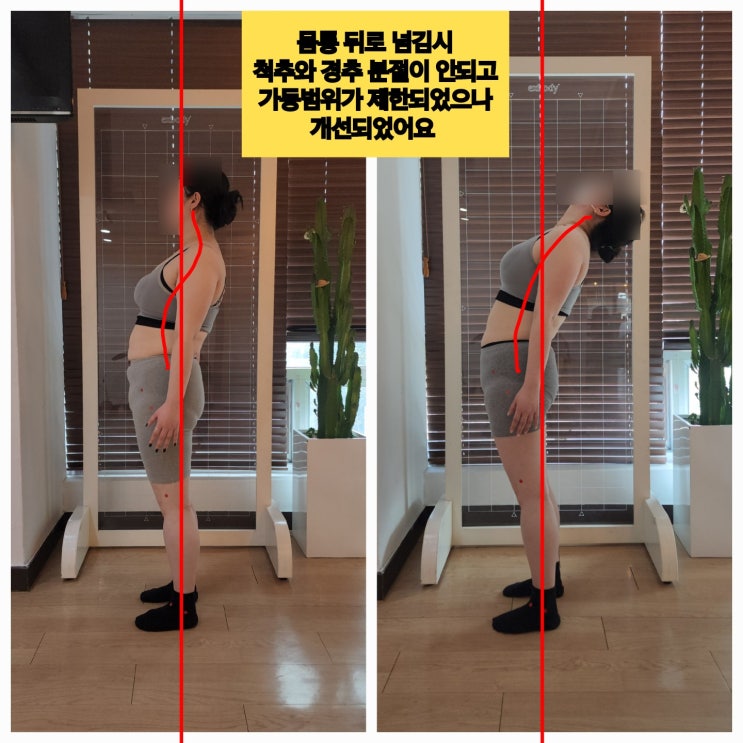  [동래 사직동 체형교정] 한달후 굽은등+목결림 자세 변화