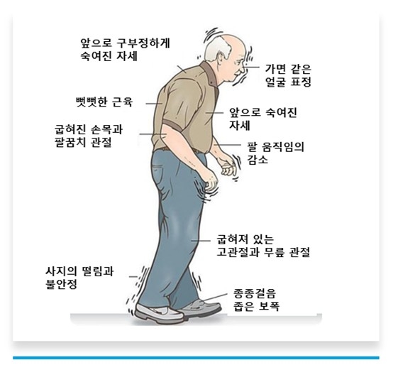 '떨림·경직' 이 질환으로 15만명 고통…"단순 노화 오인 방치"