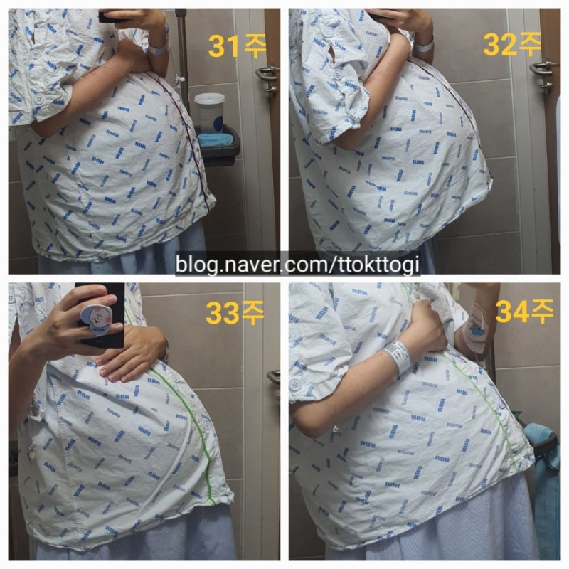 쌍둥이 대학병원 가야하는 이유 | 울산대학교병원 조기진통, 응급제왕절개 후기