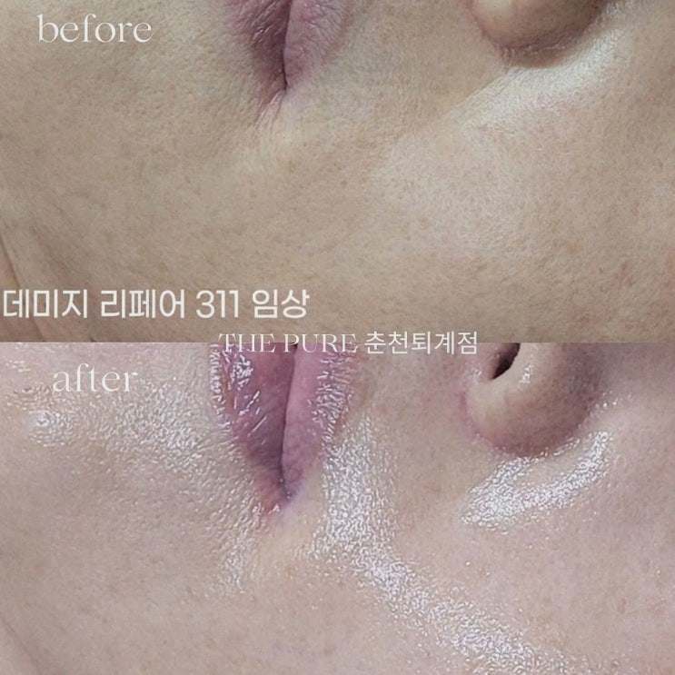  더맑은스킨 춘천퇴계점에서 퇴계동피부관리로 피부 개선 성공!