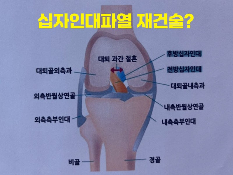 무릎십자인대파열 재건술, 해야만 하는 건가요?