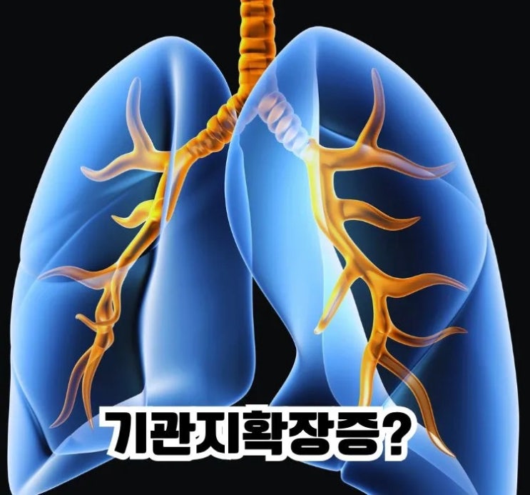  기관지확장증 무엇? 증상 원인 치료 좋은음식