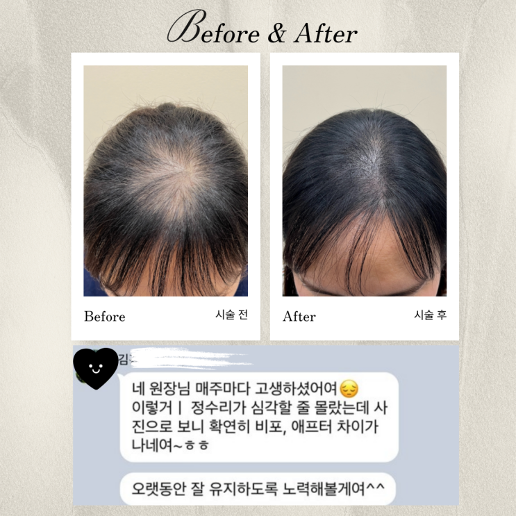  인천 송도 산후탈모 원인 및 해결 위한 두피페인팅 잘하는 곳 찾는 방법