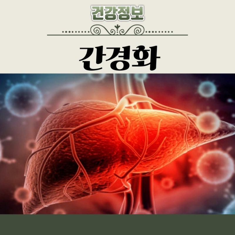 간경화 치료 방법 초기증상 원인 말기 생존율