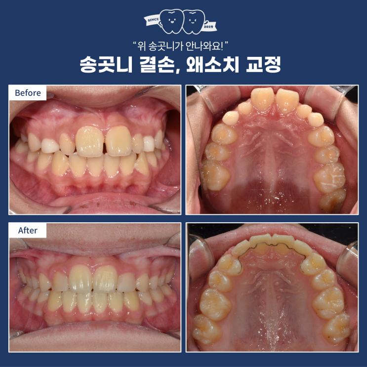  선천적 송곳니 결손과 왜소치, 정밀한 교정 계획으로 완성된 심미적 치료, 풍산역교정치과