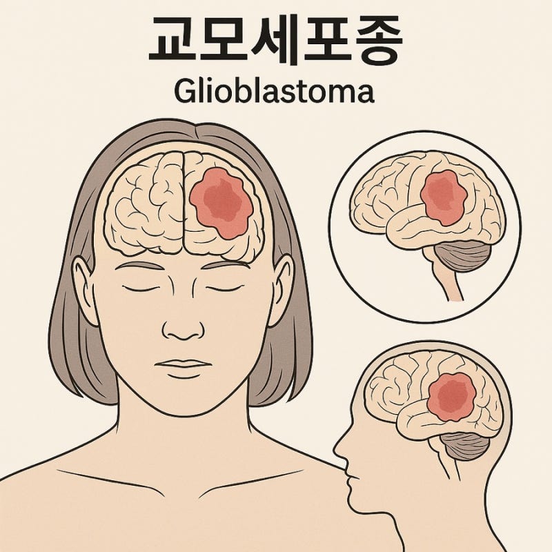 교모세포종 완치 치료 생존율 예후 증상! 수술해도 재발률 90%?