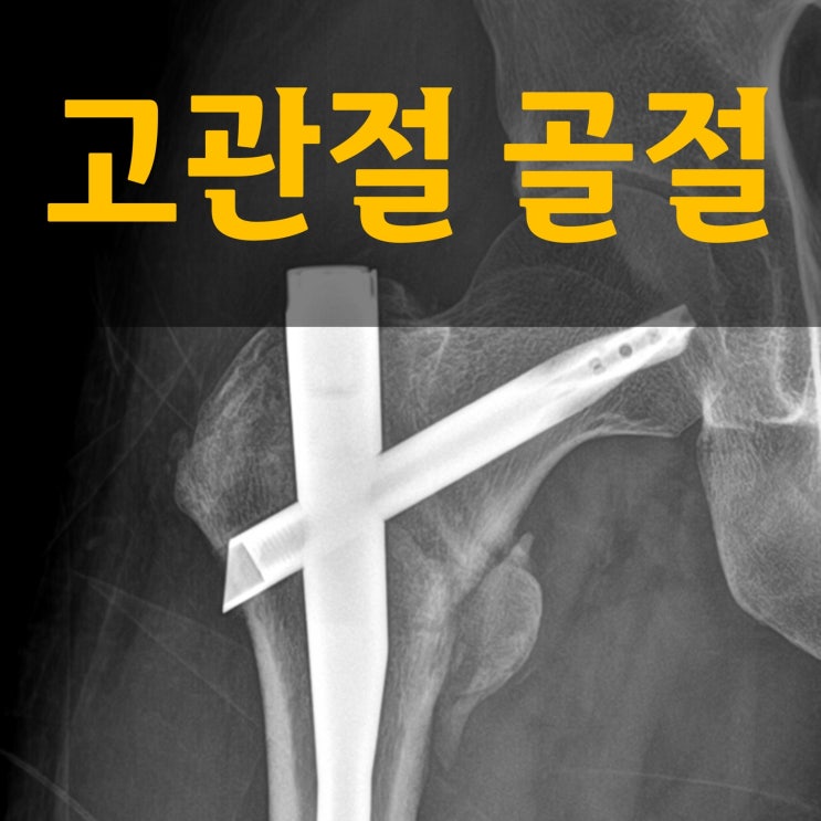  노인 고관절 골절 수술 후 회복 단계와 권장 음식