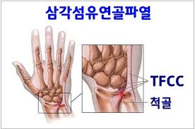  대연동PT, 경성대PT, 못골PT / TFCC 파열에 대해
