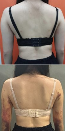  내돈내산 팔뚝람스 2주차, 후관리 후기 (통증, 멍, 고통)