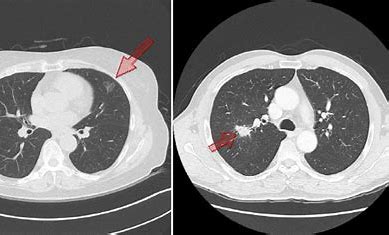 폐암(Lung Carcinoma)의 증상 및 치료