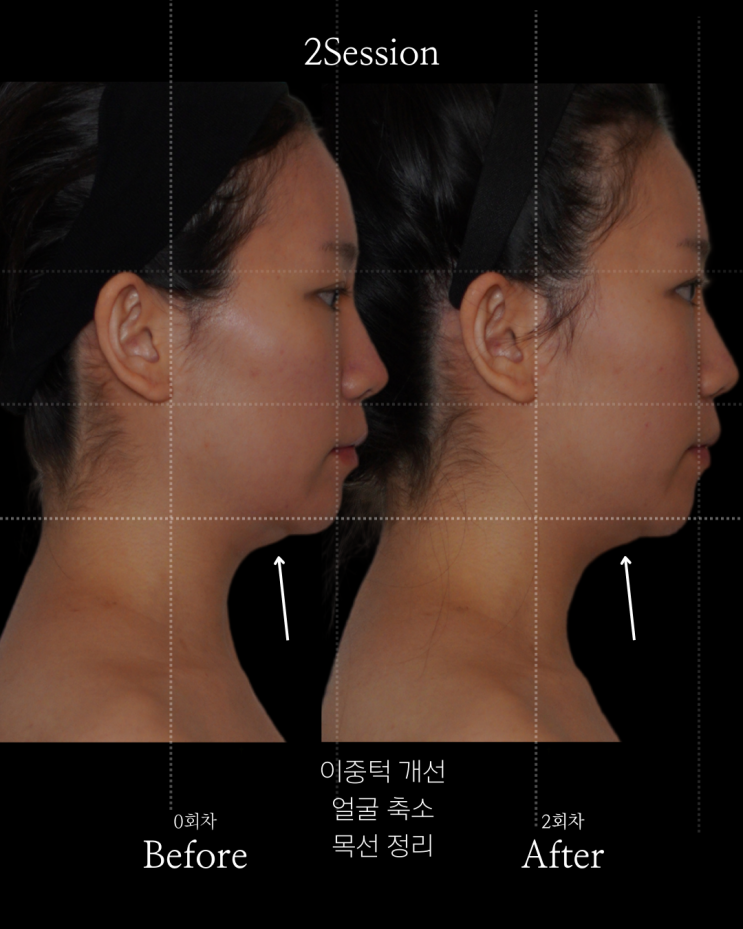  페이스 필라테스? 단 2회 만에 이중턱 없앤 비결을 공개합니다.