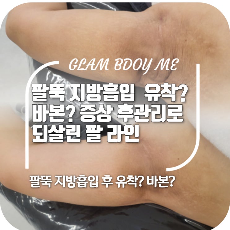  팔뚝 지방흡입 후 나타난 유착과 바본증상 후관리로 되살린 팔 라인