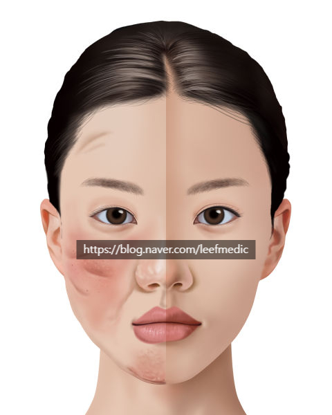  [Medical Illustration] 성형 부작용의 해부학적 묘사 – 얼굴 변화의 리스크를 시각화하다