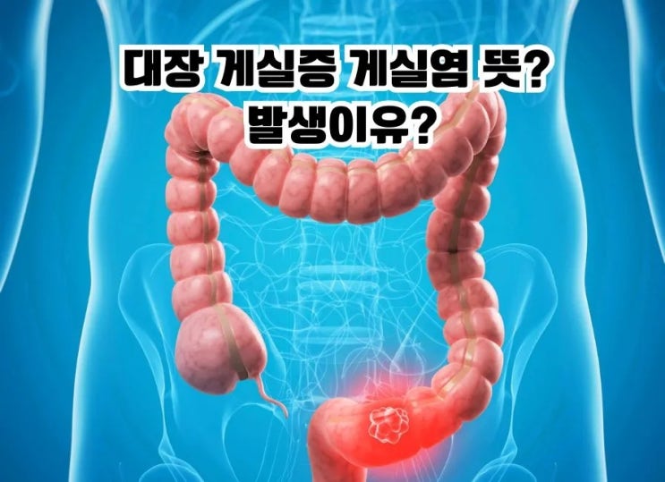  대장 게실증 게실염 뜻 발생이유 증상 원인 치료 음식