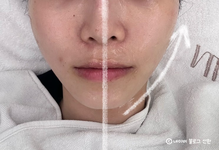  마곡웨딩관리 루아에스테틱 브이업리프팅 후기
