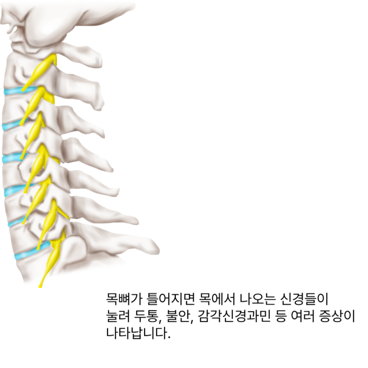  부산 서면 섬유근육통, 극심한 통증 진짜 원인은 목틀어짐에 있다?