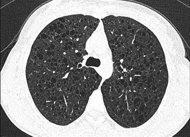 간질성 폐질환(Interstitial Lung Disease) 이란?!