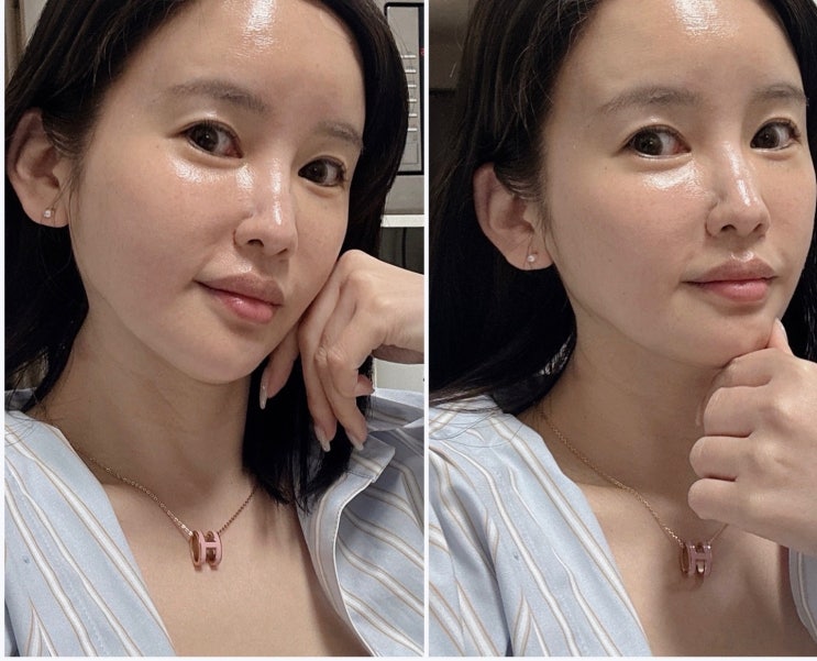 부산 서면피부과 써니리프팅 효과 좋고 통증 없었던 내돈내산 후기! 부산 서면피부과 써니리프팅 효과 좋고 통증 없었던 내돈내산 후기!