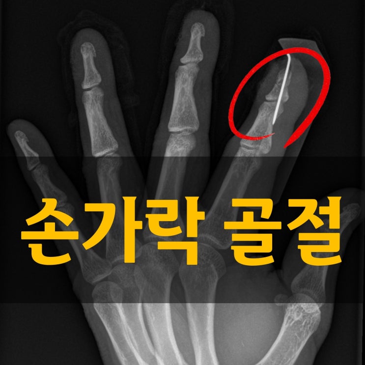  일상생활 속 큰 불편함 손가락 뼈 골절 어떤 음식이 좋을까요_한약치료