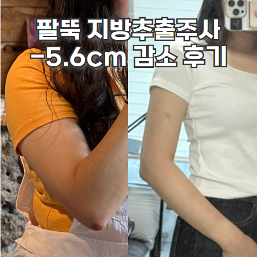  교대다이어트 병원 팔뚝 지방추출주사 효과 11주차