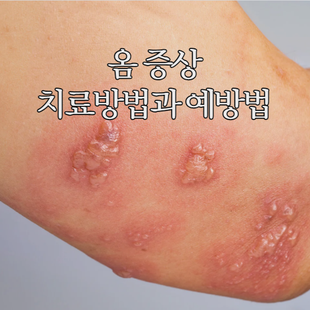  옴 증상 두드러기 가려움 초기증상 치료방법과 예방