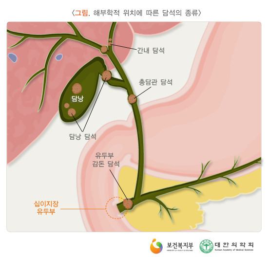  담석증일 때 칼슘 섭취를 제한할 필요는 없습니다.