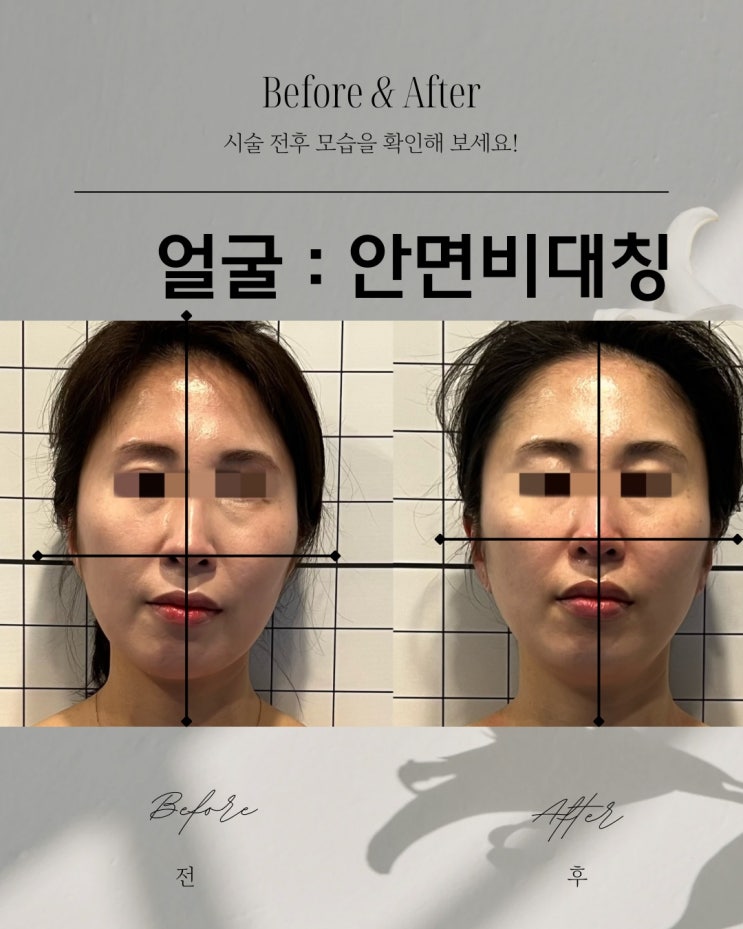 동래피부관리 비본스킨앤바디 안면비대칭, 휜코