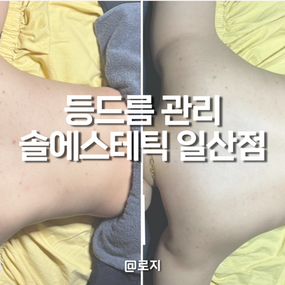  일산피부관리 여름 전 필수 등드름 관리는 백석 솔에스테틱 추천