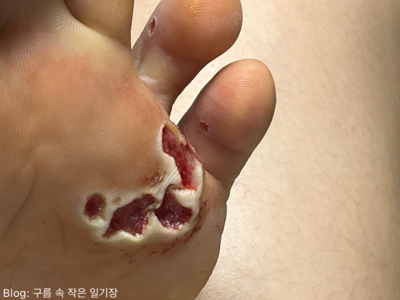 족저사마귀 | 레이저 치료 리얼후기 (7일차~11일차)