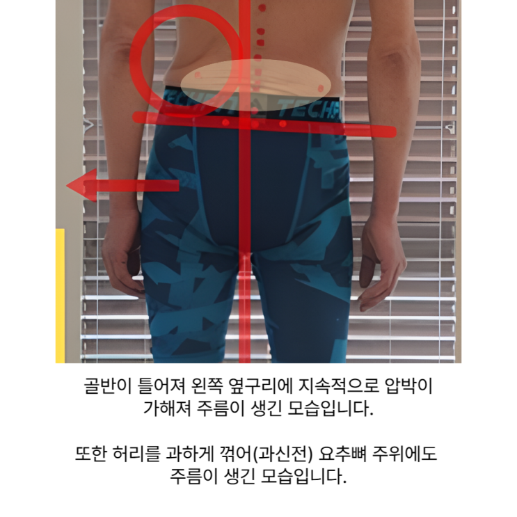  부산 서면 척추관협착증, 수술 없이 개선가능합니다(+비포에프터)