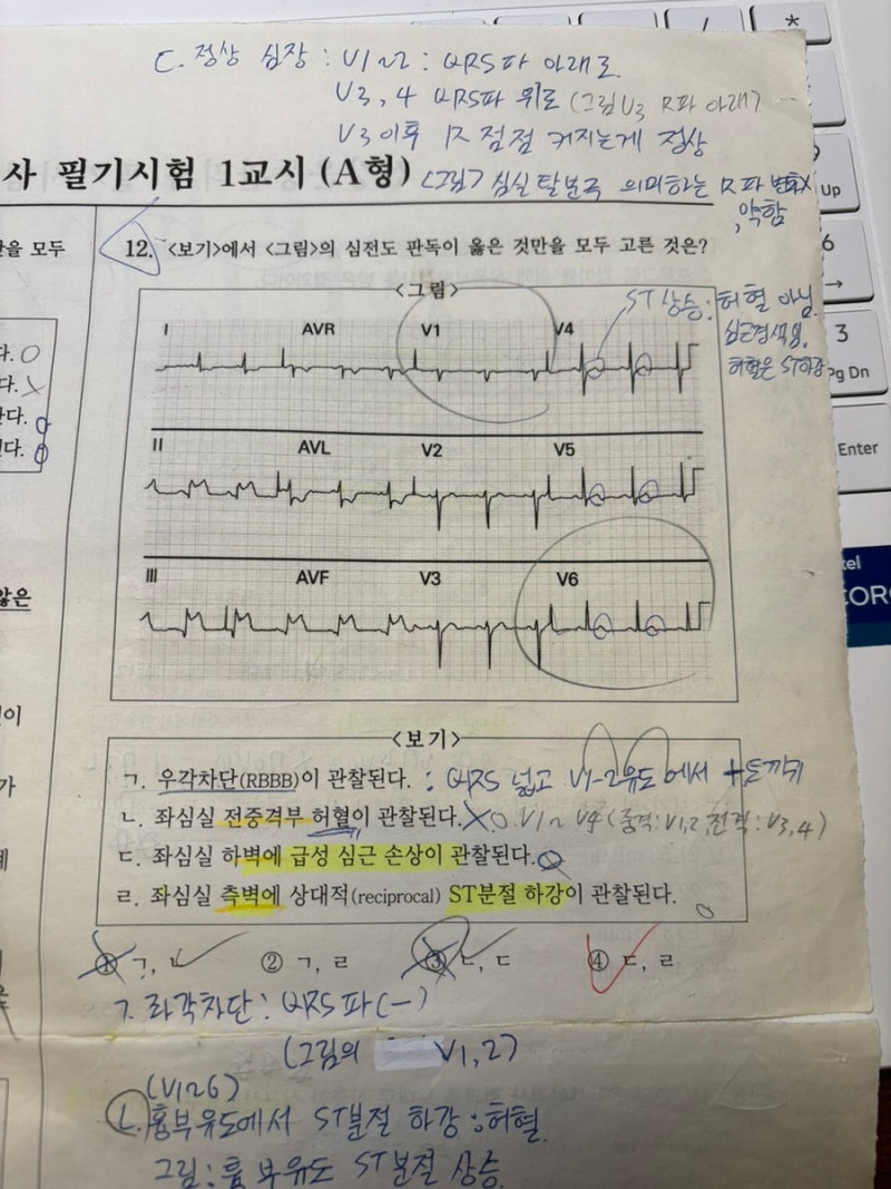 좌심실 하벽의 급성 심근손상 심전도 해석 방법(사지유도, 흉부유도)