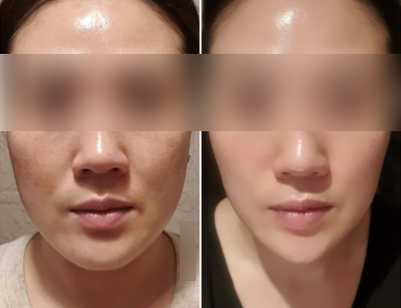  40대 팔자주름?궁금증 다 알려드릴께요(20년 경력 피부샵 원장)