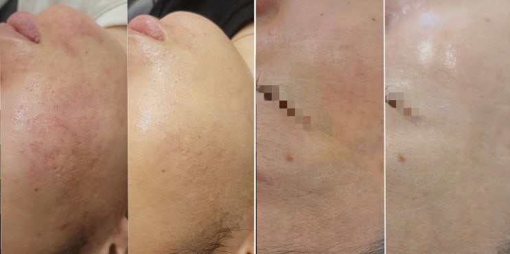  [아비에 피부&왁싱 대전점] 만족스럽고 안전한 대전왁싱 경험