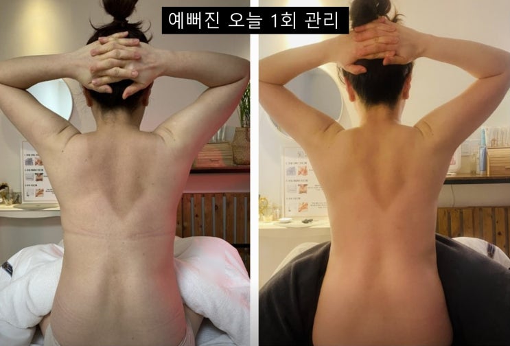  등살 빼는법? 운동만으론 부족합니다