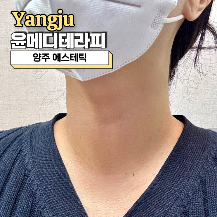  양주에스테틱, 윤메디테라피 플라즈마 잡티케어 대만족