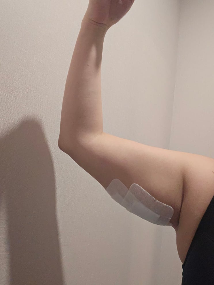  팔뚝 지방분해주사 가격 시술 1회차 통증 후기