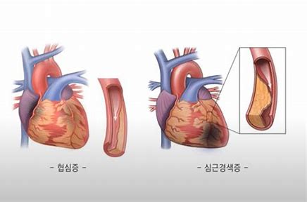 협심증이란?!