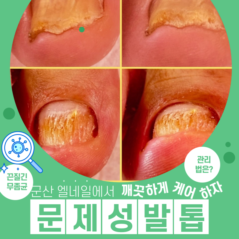 [군산무좀발톱] 발톱무좀케어는 문제성발톱 전문샵에서 아프지않게 케어 받으세요