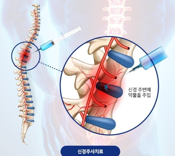 허리 신경주사 부정출혈