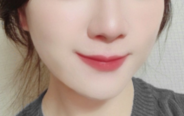  얀클리닉 쥬베룩 스킨부스터 부작용, 결절, 블룸쥬베룩 후기