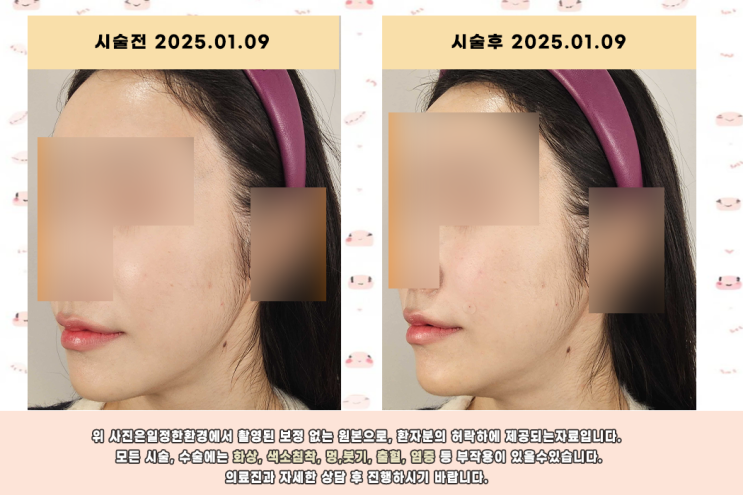  팔자주름 필러 전후 차이 효과를 만드는 치료방법