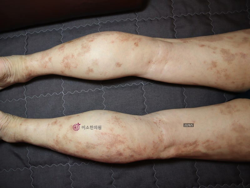 색소성자반증 치료 형태별로 다릅니다. 주의사항, 예후, 치료기간